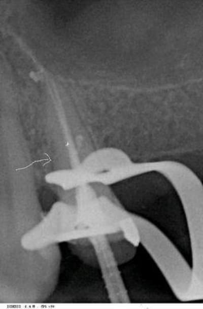 Resize of canal latéral 2 n9jcgj - Eugenol
