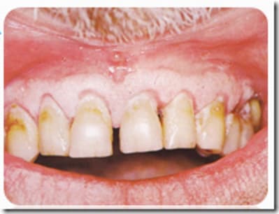 Syndromedepapillonlefvre thumb hzm6tw - Eugenol