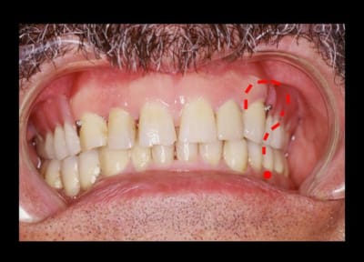 Téton benfcd - Eugenol