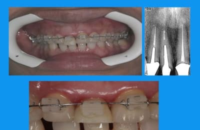 Traction 2  smeza4 - Eugenol