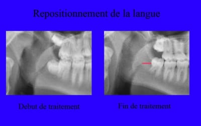 T l  radio 1 et 2 agrandissement bfj76c - Eugenol