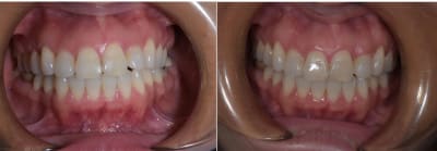 Torquing vscx5o - Eugenol