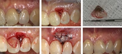 Traitement pigmentation gingivale v599ct - Eugenol
