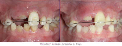 Trauma zjgnsl - Eugenol