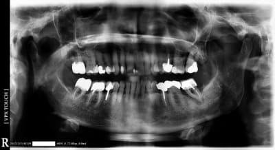 Treatmentplan olquqo - Eugenol