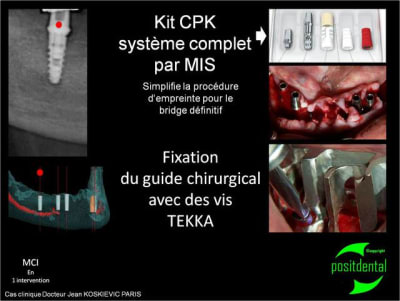 Vis tekka  kit cpk - Eugenol
