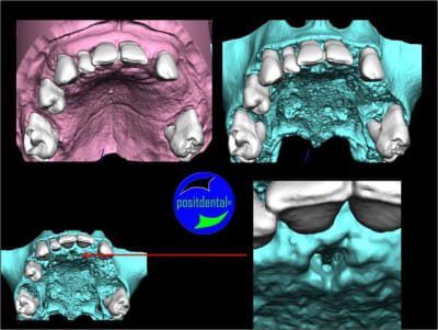 Wax up 3d positdental 5 a8a7kq - Eugenol