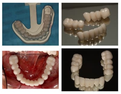 Zircone bridge p1 laahs1 - Eugenol