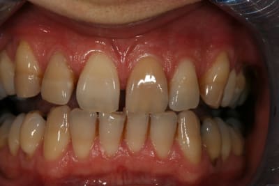  claircissement 21 avant yf1b1c - Eugenol