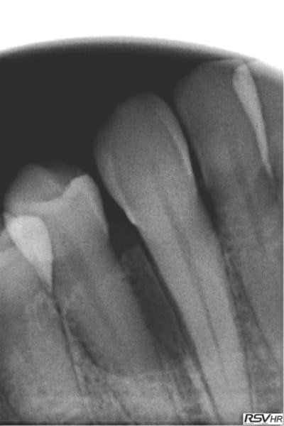 Abces lingual fr2ee1 - Eugenol