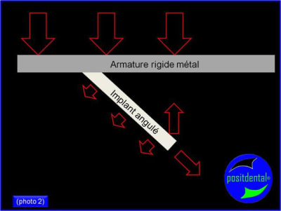 Armature m tal rigide pour mci positdental 2 uvkvoo - Eugenol