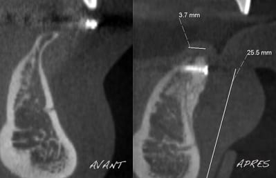 Autogenous bonegraft kusnca - Eugenol