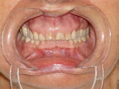 Avant traitement u2cypp - Eugenol