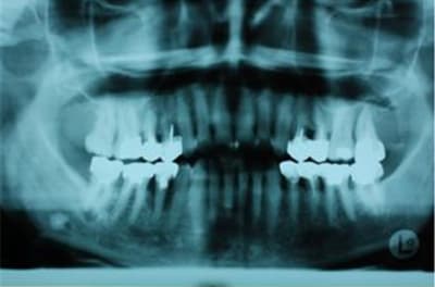 Béance osb6s4 - Eugenol