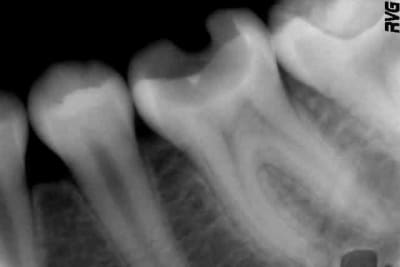 Biodentine ukewl5 - Eugenol