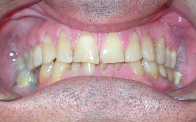Bouche ixwby2 - Eugenol