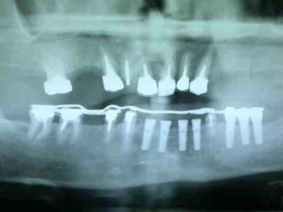 Bridge pro o5m7na - Eugenol