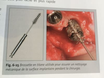 Brosse titane z0uzfd - Eugenol