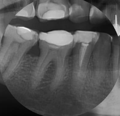 Canaux calcifi s e685ou - Eugenol