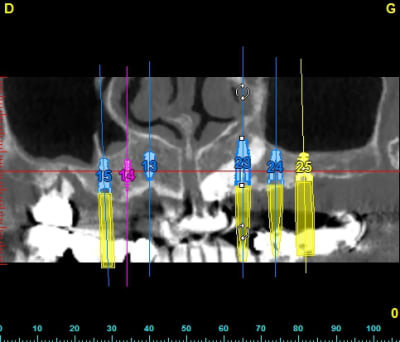 Canine panoramique fy76pg - Eugenol