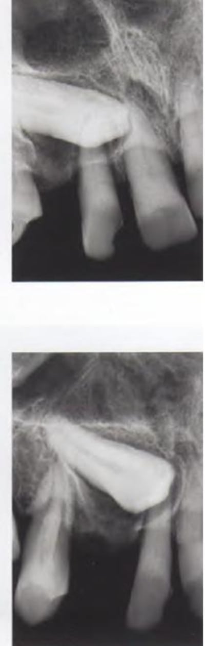 Canines palat b2qxer - Eugenol