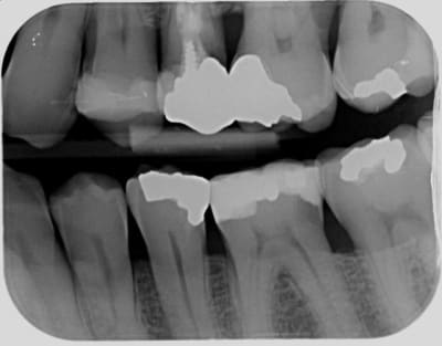 Carie2 jim6zs - Eugenol