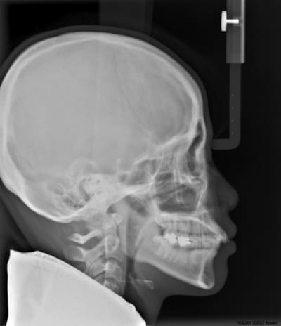 Cephalometric onyfbp - Eugenol