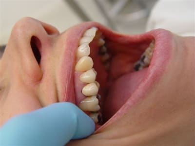 Cerec  encore une pm l0mebu - Eugenol