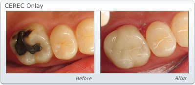 Cerec onlay yuvznx - Eugenol