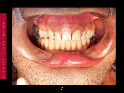 Chirurgie guidée 007 aqke93 - Eugenol