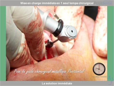 Chirurgie guidée mise en charge immédiate 0006 hzmron - Eugenol