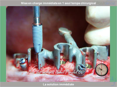 Chirurgie guidée mise en charge immédiate 0014 f9j5c4 - Eugenol