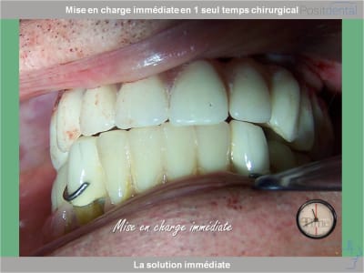 Chirurgie guidée mise en charge immédiate 0023 st1pui - Eugenol