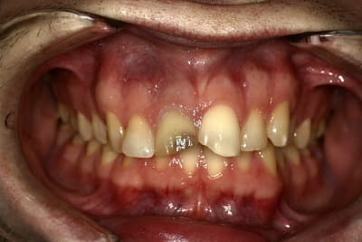 Choc obicrs - Eugenol