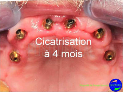 Cicatrisation gingivale suite eimci positdental 10 lvkitz - Eugenol