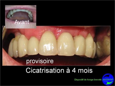 Cicatrisation gingivale suite eimci positdental 17 xjzgdz - Eugenol