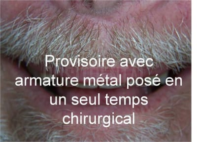 Cicatrisation gingivale suite eimci positdental 6 bb7g25 - Eugenol