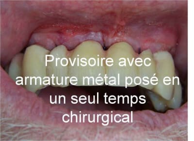 Cicatrisation gingivale suite eimci positdental 7 pfrdbi - Eugenol