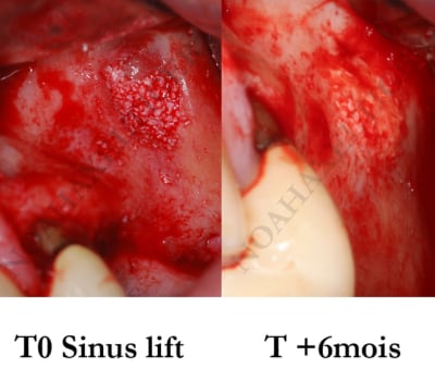 Cictrisation de la fenetre laterale xwesmc - Eugenol