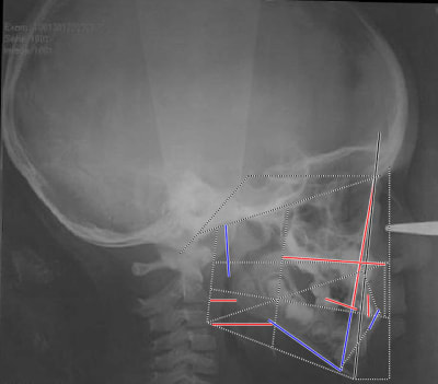 Cliii trac  architectural pyhqmc - Eugenol