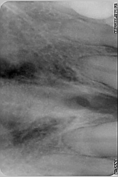 Clich  occlusal d h ufyxq4 - Eugenol