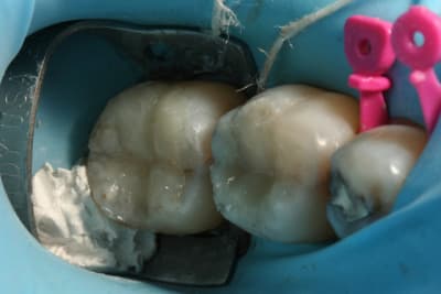 Compo digue strz56 - Eugenol