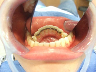 Contention collée f1ahba - Eugenol