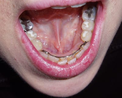 Contention fwuvzy - Eugenol