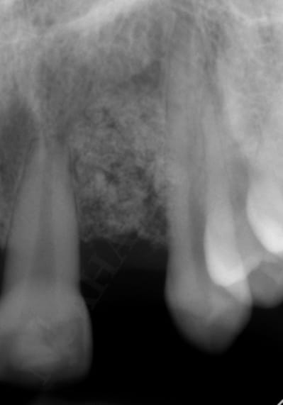 Controle rx avant implantation t8bfix - Eugenol