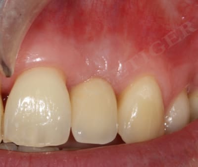 Controle clinique   1 an xuagpl - Eugenol