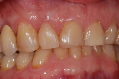 Couronne cerec mdiqnf - Eugenol