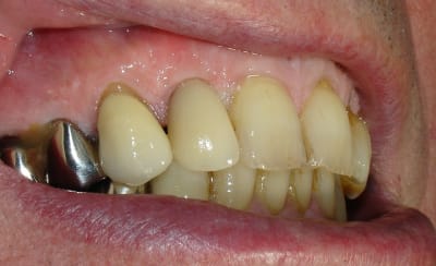 Couronne en place mfxepr - Eugenol