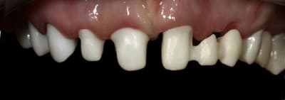 Couronne et bridge2 jtxmb1 - Eugenol