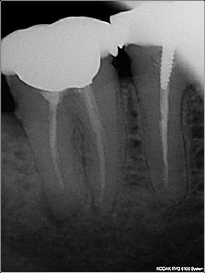 Crochet apical 1 rqap4c - Eugenol